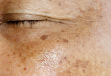 Sposoby zapobiegania i niwelowania hiperpigmentacji skóry twarzy w gabinecie kosmetologicznym