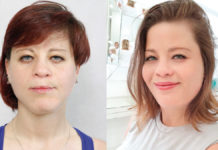 Na drodze do pięknych ust – metody poprawy wyglądu twarzy u osób po rozszczepie wargi lub podniebienia