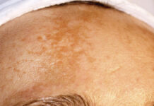 Zaburzenia barwnikowe