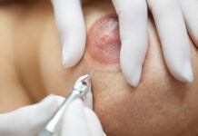 Kamuflaż blizn i rekonstrukcja otoczki brodawki sutkowej piersi u kobiet po mastektomii