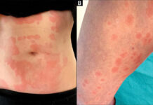 Dermatozy skórne towarzyszące zakażeniu COVID-19 – przegląd piśmiennictwa