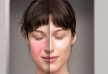 Hormony a zdrowie skóry. Rola kosmetologa w terapii dermatoz związanych z zaburzeniami układu dokrewnego