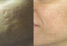 Sztuka kontrolowanego uszkodzenia skóry. Mezoterapia i peelingi chemiczne w jednej procedurze zabiegowej – autorskie terapie łączone