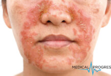 Zaburzenia skórne w chorobie Parkinsona