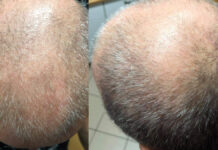 Wpływ choroby Hashimoto na mieszki włosowe u mężczyzn