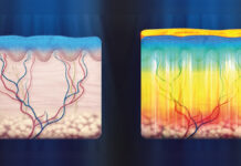 Kierunki rozwoju światłolecznictwa. Pulsacyjna energia fluorescencji w terapiach przeciw trądzikowi pospolitemu oraz różowatemu