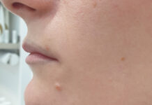 Bezpieczne i efektywne usuwanie tatuaży i makijażu permanentnego. Technika łączenia laserów ablacyjnych i Q-switched z perfluorowęglowodorami