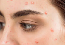 Styl życia a trądzik