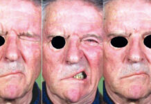 Przegląd metod fizykalnych w terapii porażenia nerwu twarzowego typu Bella