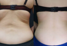 Kriolipoliza CLATUU ALPHA. Wzrost potrzeb estetycznych społeczeństwa a rozwój dostępnych procedur i urządzeń