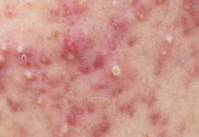 Probiotyki w pielęgnacji skóry trądzikowej. Przegląd najnowszych doniesień naukowych