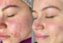 Trądzik hormonalny. Przyczyny, terapia oraz pielęgnacja