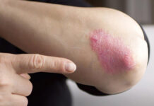 Zachowania dietetyczne a przebieg łuszczycy