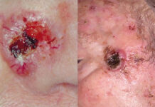 Profilaktyka pierwotna i wtórna nowotworów skóry