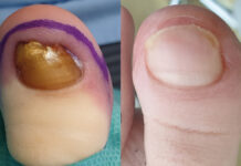 Rola i zadania zespołu interdyscyplinarnego w terapii aparatu paznokciowego. Część 1. Przerost guzowatości paliczka dystalnego