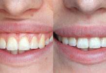 Korekta ust po rozszczepie oraz u osób z gummy smile za pomocą kwasu hialuronowego