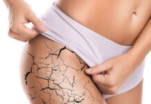 Wybrane terapie rozstępów wykorzystywane w gabinetach kosmetologicznych