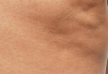 Wpływ liposukcji ultradźwiękowej na redukcję cellulitu. Dieta jako element terapii