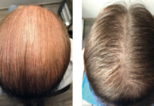 Nadmierna utrata włosów jako powikłanie po zakażeniu wirusem SARS-CoV-2