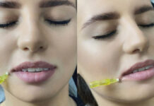 Modelowanie ust nićmi PDO jako alternatywa dla wypełniaczy