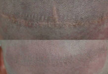 Mikropigmentacja blizn na skórze głowy