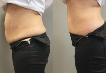 Adipologie – niezwykła skuteczność w modelowaniu ciała
