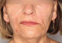 Miomodulacja – metoda wspomagająca funkcję mięśni mimicznych