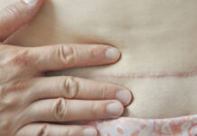 Terapia manualna blizny na przykładzie blizny po cesarskim cięciu