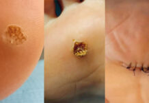 Porównanie skuteczności terapii nieinwazyjnych i inwazyjnych w zabiegach usuwania brodawek wirusowych skóry stóp