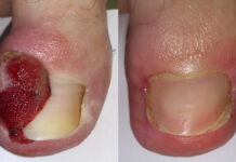 Rola i zadania zespołu interdyscyplinarnego w terapii aparatu paznokciowego. Część 2. Wrastające paznokcie