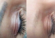 Czynniki wpływające na skuteczność usuwania makijażu permanentnego i tatuażu laserem Q-switch