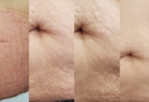 Zastosowanie lasera frakcyjnego ablacyjnego CO2 i frakcyjnych laserów nieablacyjnych pikosekundowych 1064 nm i 755 nm oraz mezoterapii igłowej w terapii łączonej w redukcji rozstępów i wiotkości skóry. Przypadek kliniczny