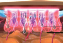 Lasery do epilacji – najważniejsze kryteria wyboru