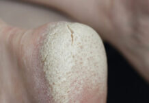 Wpływ choroby Hashimoto na skórę, włosy i paznokcie