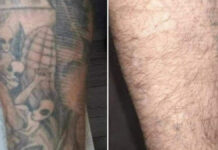 Bezpieczne i skuteczne usuwanie pigmentacji