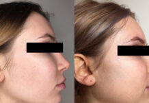 Kwas trójchlorooctowy (TCA) i jego synergistyczne współdziałanie z kwasem migdałowym i kojowym