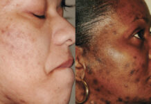 Skóra o fototypie IV-VI – charakterystyka dermatoz oraz ryzyko pojawienia się efektów niepożądanych w wyniku terapii kosmetologicznych