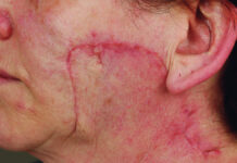 Zastosowanie laserów w terapii blizn