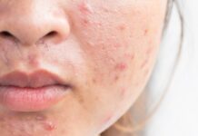 Możliwości zastosowania olejów roślinnych w pielęgnacji skóry trądzikowej