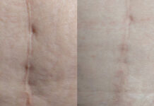 Terapia blizn – model pracy z niedoskonałościami skóry