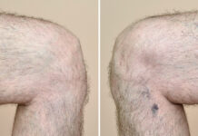 Laserowe zamykanie naczyń w praktyce. Skuteczność a ryzyko powikłań