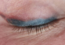 Laserowe usuwanie pigmentacji z powiek. Procedury oraz możliwe efekty uboczne
