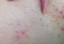 Trądzik. Rodzaje, etiologia, objawy, leczenie