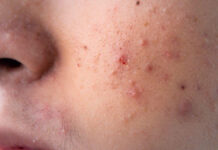 Wpływ insulinopodobnego czynnika wzrostu IGF-1 na występowanie trądziku pospolitego