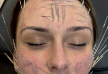 Needle Shaping i Thuzzle. Duet idealny w medycynie regeneracyjnej