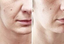 Radiofrekwencja mikroigłowa – zabieg wielozadaniowy, nie tylko dla skóry dojrzałej