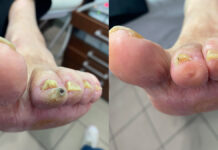 Hiperkeratozy – skalpel czy frezarka?