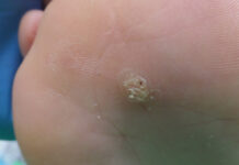 Terapie brodawek wirusowych w gabinecie podologicznym