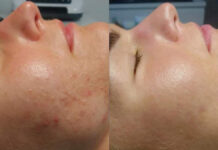 Oczyszczanie twarzy w gabinecie kosmetologicznym