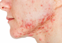 Rola stresu, rytmu okołodobowego oraz zmian hormonalnych w trądziku późnym